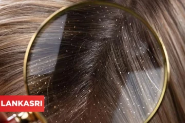 பொடுகு தொல்லையால் அவதியா? இதனை போக்க இந்த ஒரு பொருளை மட்டும் பயன்படுத்தி பாருங்க