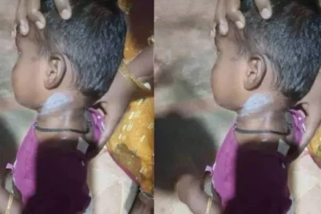 2 வயது குழந்தை சேட்டை செய்ததால் சூடு வைத்த அங்கன்வாடி ஊழியர்