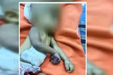 ஒன்றரை வயது குழந்தையின் கை அகற்றப்பட்டது இதனால் தான்! அமைச்சர் கூறும் விளக்கம் என்ன?