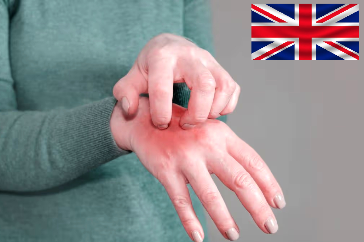 UK-Crusted-Scabies-Outbreak-Rare-Skin-Disease