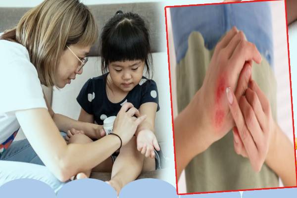 தீக்காயம் ஏற்பட்டால் இந்த தவறை மட்டும் பண்ணாதீங்க! பாதிப்பு உறுதி | How To Treat Minor Cooking Burns