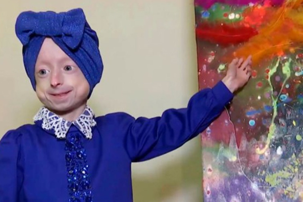 10 வயதில் 80 வயது தோற்றம் - அரியவகை நோயால் பாதிக்க சிறுமி மரணம்! | World