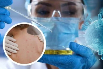 monkeypox பரவல் எதிரொலி: விமான நிலையங்களில் கண்காணிப்பு அதிகரிப்பு