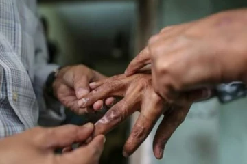 இலங்கையில் அதிகரிக்கும் சிறுவர் தொழுநோயாளர்களின் எண்ணிக்கை