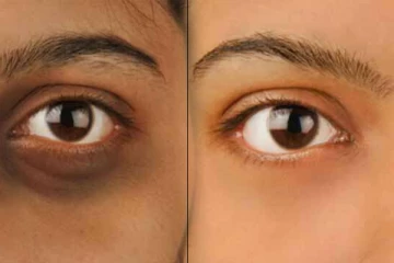 படாதபாடு பட்டும் கருவளையம் போகவில்லையா? இரண்டே நாட்களில் போக சூப்பர் டிப்ஸ்