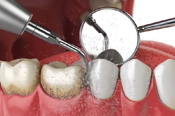 ஈறு அழற்சி பிரச்சினை முடிவுக்கட்டும் பூண்டு சாறு ஈறு அழற்சி பிரச்சினை முடிவுக்கட்டும் பூண்டு சாறு