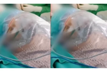 மூளைக் கட்டிக்கு அறுவை சிகிச்சையின்போது பாட்டு பாடிய நபர் - வைரலாகும் வீடியோ