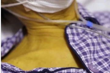 திடீரென மஞ்சள் நிறமாக மாறிய நபர்... மருத்துவர்களின் கண்டுபிடிப்பும் கோரிக்கையும்