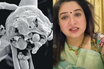 கருப்பு பூஞ்சை எவ்வாறு ஏற்படுகின்றது? மருத்துவர் அனிதா விஜயகுமார் கூறும் விளக்கம்!