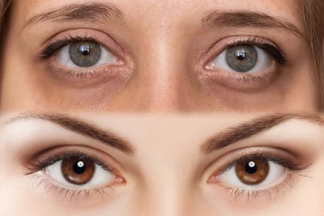 இந்த எண்ணெய் ஒரு சொட்டு இருந்தால் போதும்... கருவளையம் உடனே மறைந்துவிடும்