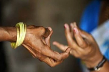 இலங்கையில் அண்மைக்காலமாக அதிகரிக்கும் தொழுநோயாளிகள்!