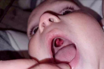 10 மாத குழந்தையின் தொண்டையில் இருந்த பயங்கரமான ஓட்டை! பதறியடித்து மருத்துவமனைக்கு சென்ற தாய் செய்த அலப்பறை!