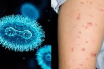 මන්කිපොක්ස් රෝගය මේ වන විට ලොව පුරා පැතිර ගොස් තිබෙනවා.