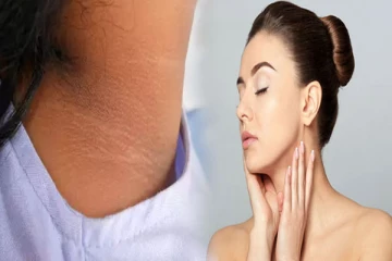 கழுத்து கருப்பாக இருக்கிறதா? இந்த வீட்டு வைத்தியத்தை ட்ரை பண்ணி பாருங்க