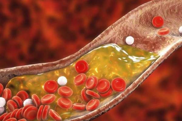 முகத்தில் கொலஸ்ட்ரால் அறிகுறிகள்: உங்கள் கண்களுக்கு கீழ் இப்படி உள்ளதா? | Cholesterol Symptoms On The Face