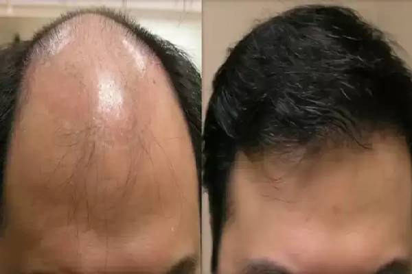 வழுக்கை தலையில் முடி வளர வைக்கும் ஸ்கால்ப் மசாஜ்! எப்படி செய்வது? | Scalp Massage With Oil For Hair Regrowth