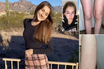 தண்ணீரை குடித்தால் ஆசிட் போன்று எரியும்... இளம்பெண்ணுக்கு ஏற்பட்ட விசித்திர நோய்!