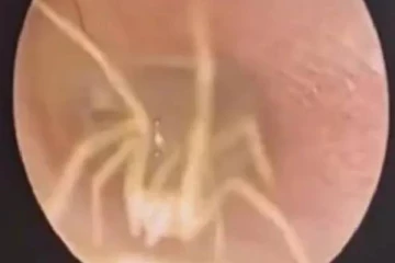 இளம்பெண்ணின் காதுக்குள் உயிருடன் வாழ்ந்த சிலந்தி பூச்சி: மருத்துவர்கள் கண்ட அதிர்ச்சி காட்சி