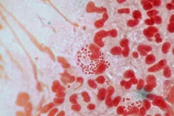 கனடாவில் ஆபத்தான பால்வினை நோய் தொடர்பில் எச்சரிக்கை