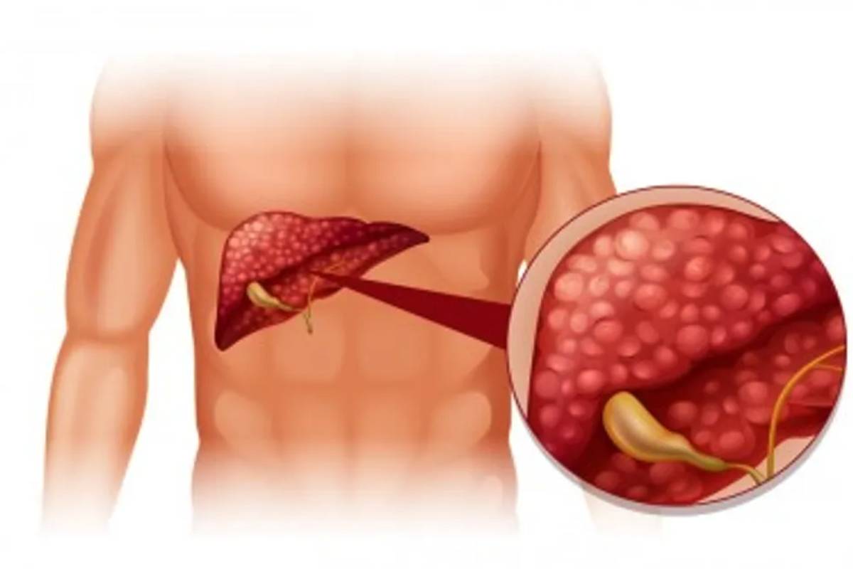 உள்ளங்கையில் இந்த அறிகுறி இருக்கா? கல்லீரல் பத்திரம் | Palm Symptom Of Liver Damage Doctors Warn