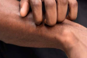 வெப்பமான வானிலை காரணமாக தோல் நோய்கள்