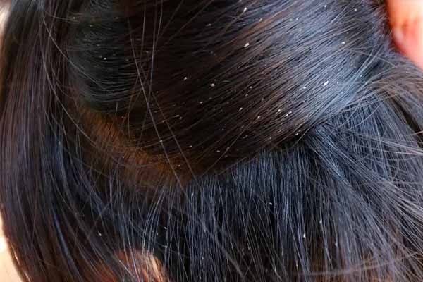 பேன் தொல்லையால் 12 வயது சிறுமி மரணம் | 12 Year Old Died Due To Lice Infection