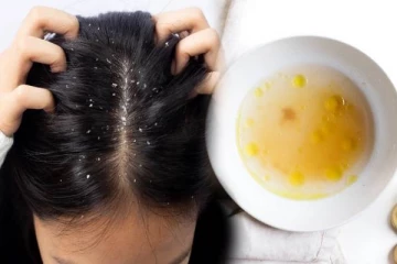 பொடுகு தொல்லையை நிரந்தரமாக நீக்க இந்த 2 பொருள் போதும்.., எப்படி பயன்படுத்துவது?