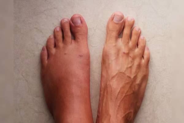 தக்காளியை அதிகமாக சாப்பிடுவதால் எந்த நோய் வரும்? | Which Disease Caused By Eating Tomatoes