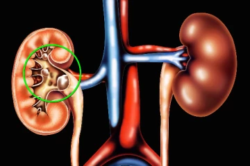 වකුගඩු වල ගල් හටගෙන ඇති බවට හඟවන රෝග ලක්ෂණ