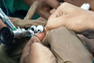 மூச்சுக்குழாயில் சிக்கிய நாணயம்... 8 ஆண்டுகளுக்கு பின் அகற்றிய மருத்துவர்கள்!