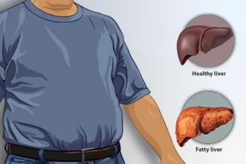 අක්මාවේ තෙල් තැම්පත්වීම සුව කරන විධි.