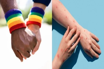 உயிரை கொல்லும் குரங்கு அம்மை..ஓரின சேர்க்கையாளர்களுக்கு அதிக பாதிப்பா? பகீர் ஆய்வு!