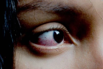 கண்களில் இரத்தம் கசியும்... மூன்றில் ஒருபங்கு நோயாளிகள் மரணம்: கதிகலங்கும் ஐரோப்பிய நாடு