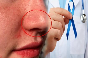 மூக்கில் சிவப்பு புள்ளிகள் இருப்பது புற்றுநோயின் அறிகுறியா? அவசியம் தெரிஞ்சிக்கோங்க