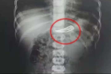 ஹேர் கிளிப்பை விழுங்கிய குழந்தை... 10 நிமிடத்தில் மருத்துவர்கள் செய்த செயல்