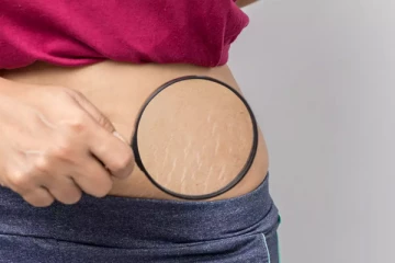 பிரசவத்துக்கு பின் வரும் தழும்புகள் எளிய முறையில் மறைக்க வேண்டுமா? இதோ சில சூப்பரான டிப்ஸ்