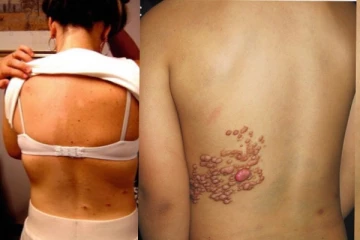 ශරීය පුරා පැතිරයන අති භයානක රෝගයක් ලංකාවෙන්..මේ අය දරුවන් හදන්න එපා..