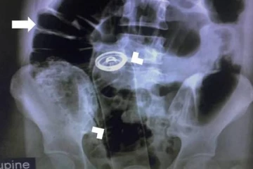 வயிற்று வலியால் அவதிப்பட்ட இளைஞர்! ஆசனவாய் பரிசோதனையில் தெரியவந்த உண்மை