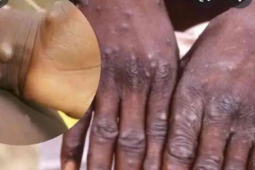 පළමු වරට වඳුරු උණ රෝගියා ලංකාවෙන් හමුවෙයි..