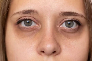 கண்களுக்குக் கீழே உள்ள கருவளையங்கள் சில நாட்களில் குறையும், இவற்றை முயற்சிக்கவும்