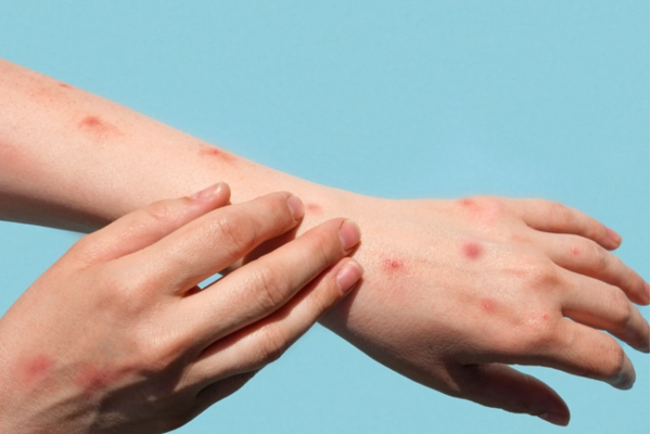 தீவிரமாக பரவும் குரங்கு அம்மை நோய் - பாதிப்போர் எண்ணிக்கை கிடு கிடு உயர்வு..! | Severely Contagious Monkey Pox