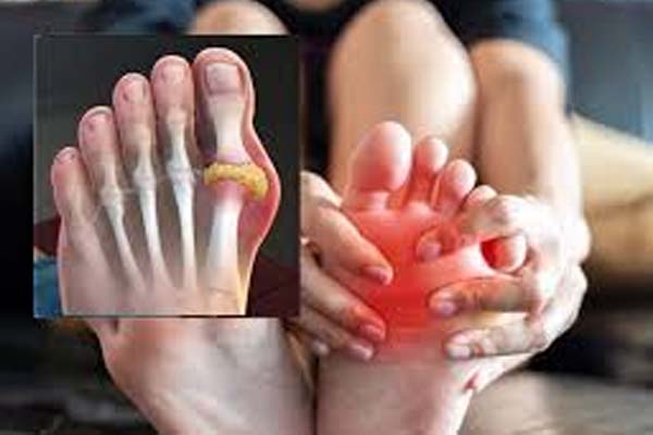 யூரிக் அமில பிரச்சனையால் அவதியா? இந்த உணவுகளை எடுத்துக்கோங்க | Which Food Eat Uric Acid Control யூரிக் அமில பிரச்சனையால் அவதியா? இந்த உணவுகளை எடுத்துக்கோங்க | Which Food Eat Uric Acid Control