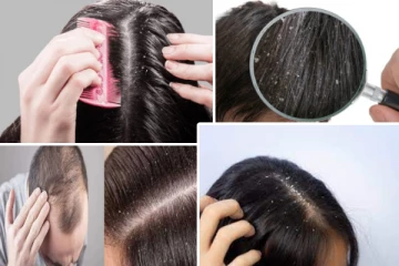 பொடுகு தொல்லையா... இதை செய்தால் ஒரே குளியலில் தீர்வு!