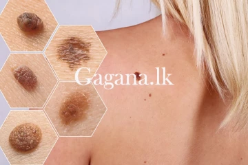 තත්වය අවධානම් වෙන්න කලින් චර්ම පිළිකා හඳුනාගන්නේ මෙහෙමයි.