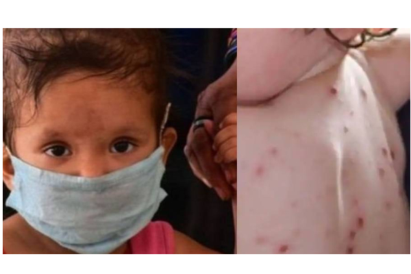 கேரளாவில் குழந்தைகளை குறி வைத்து தாக்கும் ‘தக்காளி வைரஸ்’- 85 குழந்தைகள் மருத்துவமனையில் அனுமதி - மக்கள் அச்சம் - தமிழ்நாடு