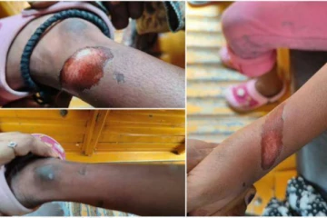 6 வயது மனவளர்ச்சி குன்றிய சிறுமிக்கு சூடு வைத்த ஆசிரியை - பதற வைக்கும் அதிர்ச்சி சம்பவம்