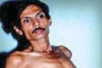 36 ஆண்டுகளாக வீங்கிய வயிறு., உள்ளே இருந்ததை பார்த்து திகைத்துப்போன மருத்துவர்கள்