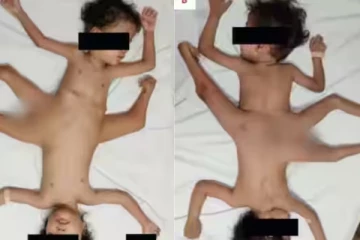 ஸ்பைடர் ட்வின்ஸ் - 4 கை 3 கால்களுடன் ஒட்டிப்பிறந்த இரட்டையர்களை !!