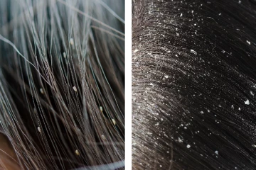 தாங்க முடியாத பொடுகு தொல்லையா?  நீங்க என்ன செய்யணும் தெரியுமா?