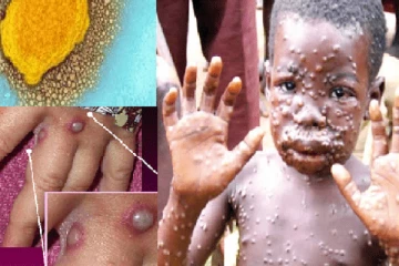 இந்தோனேசியாவில் முதன்முறையாக குரங்கு அம்மை கண்டறிவு